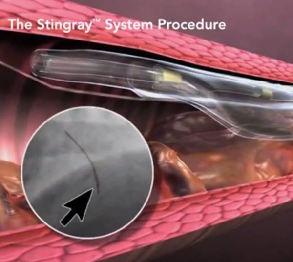 Coronary Chronic Total Occlusion Cto System Boston Scientific